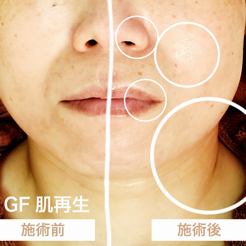 GF肌再生Before-After